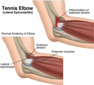 b2ap3_thumbnail_TennisElbow_LG