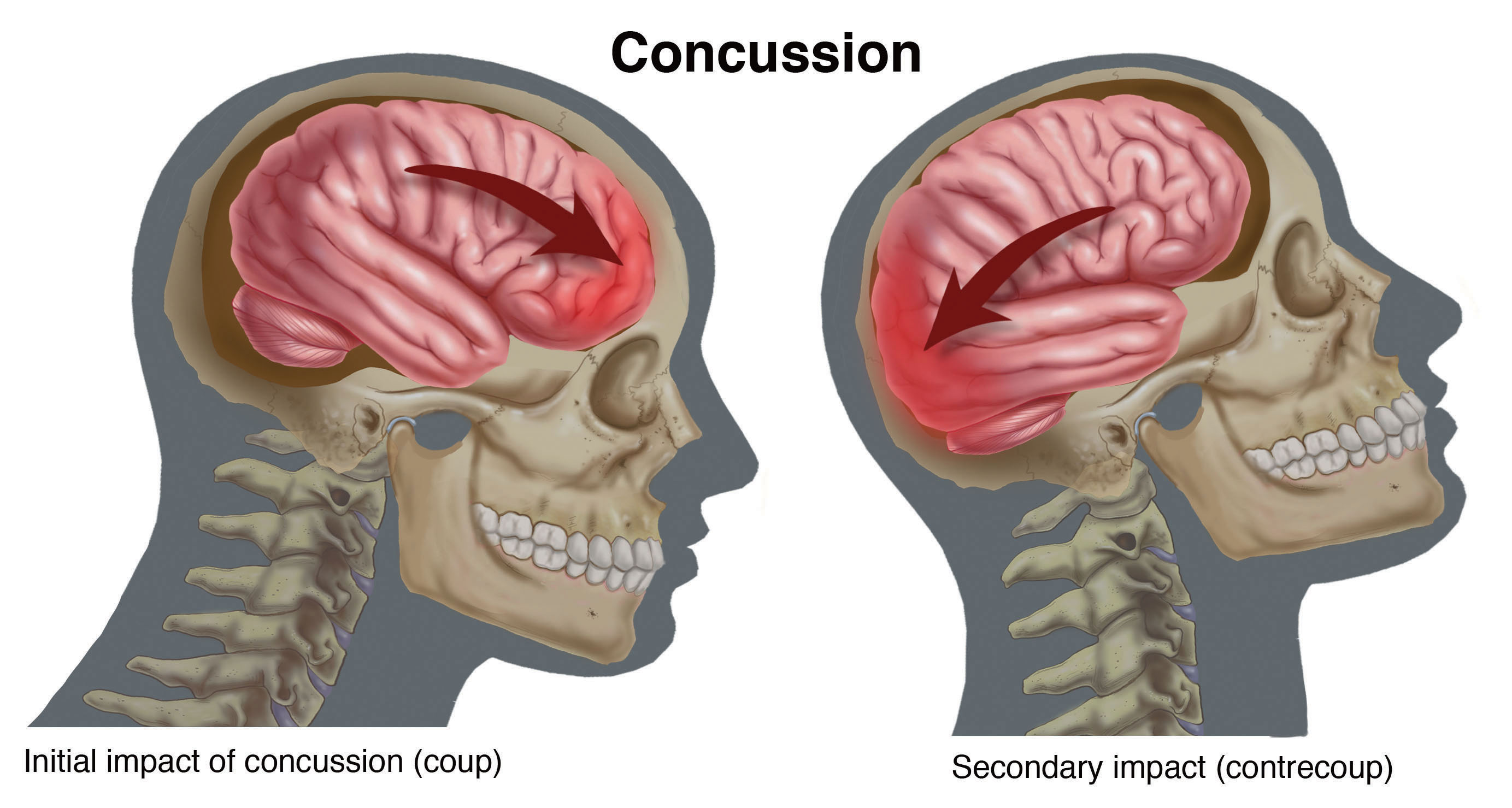 concussion